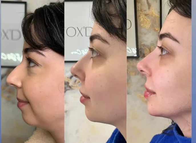 Dermal Fillers - before and after - W Aesthetics in Austin, TX
