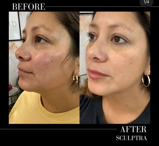 Dermal Fillers - before and after - W Aesthetics in Austin, TX