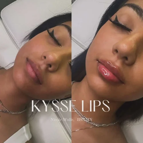 Dermal Fillers - before and after - W Aesthetics in Austin, TX