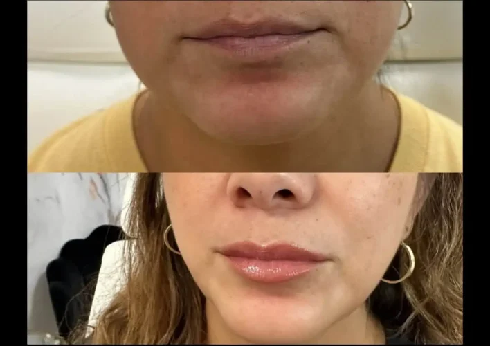 Dermal Fillers - before and after - W Aesthetics in Austin, TX