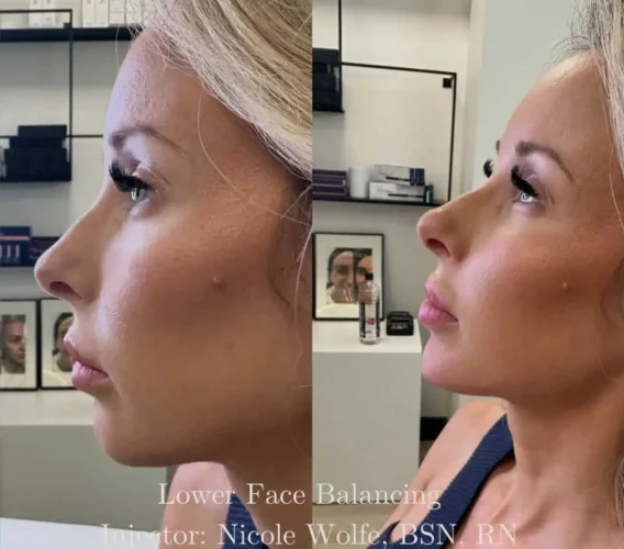 Dermal Fillers - before and after - W Aesthetics in Austin, TX