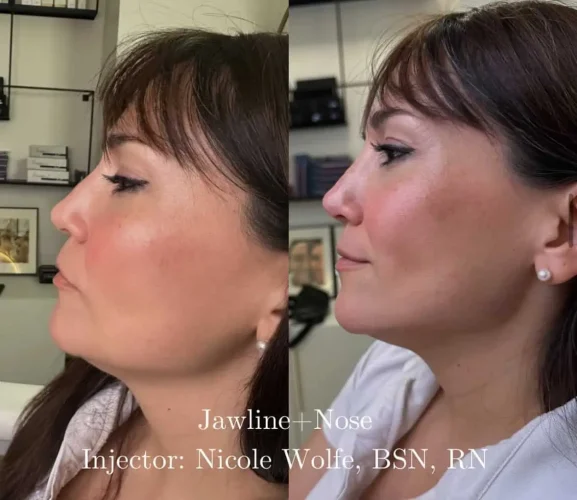 Dermal Fillers - before and after - W Aesthetics in Austin, TX