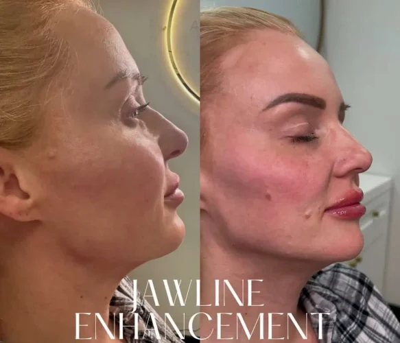 Dermal Fillers - before and after - W Aesthetics in Austin, TX
