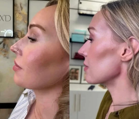 Dermal Fillers - before and after - W Aesthetics in Austin, TX