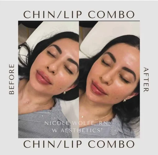 Dermal Fillers - before and after - W Aesthetics in Austin, TX