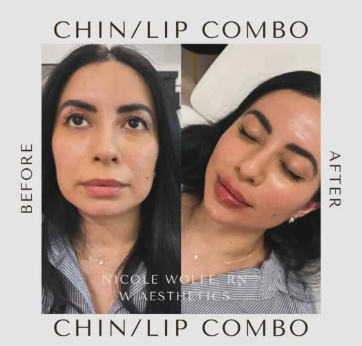 Dermal Fillers - before and after - W Aesthetics in Austin, TX
