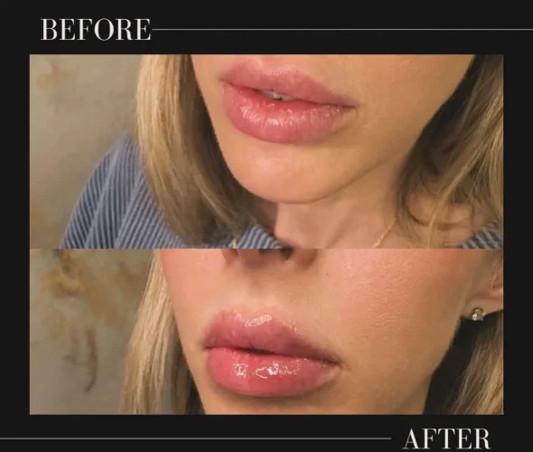 Dermal Fillers - before and after - W Aesthetics in Austin, TX