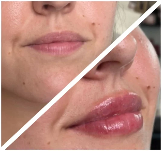 Dermal Fillers - before and after - W Aesthetics in Austin, TX