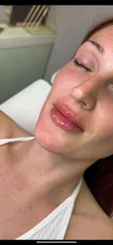 Dermal Fillers - before and after - W Aesthetics in Austin, TX