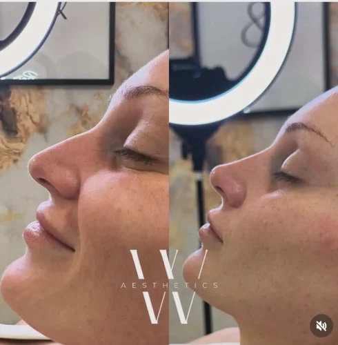 Dermal Fillers - before and after - W Aesthetics in Austin, TX