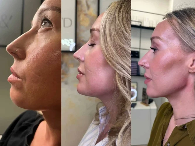 Dermal Fillers - before and after - W Aesthetics in Austin, TX