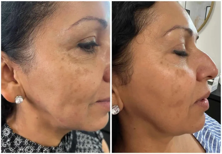 Dermal Fillers - before and after - W Aesthetics in Austin, TX