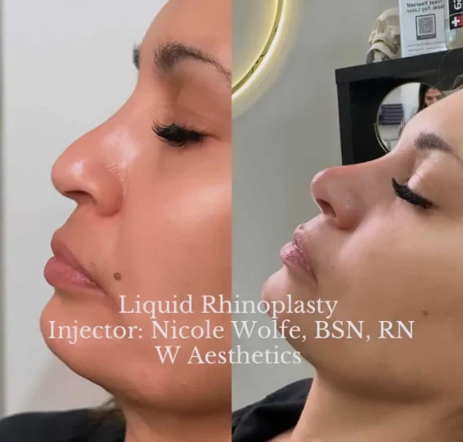 Dermal Fillers - before and after - W Aesthetics in Austin, TX