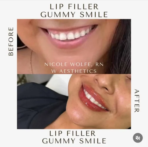 Dermal Fillers - before and after - W Aesthetics in Austin, TX