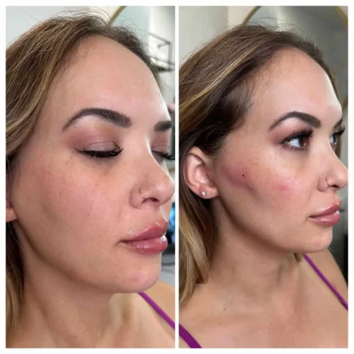 Dermal Fillers - before and after - W Aesthetics in Austin, TX