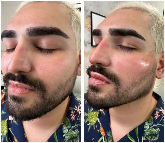 Dermal Fillers - before and after - W Aesthetics in Austin, TX